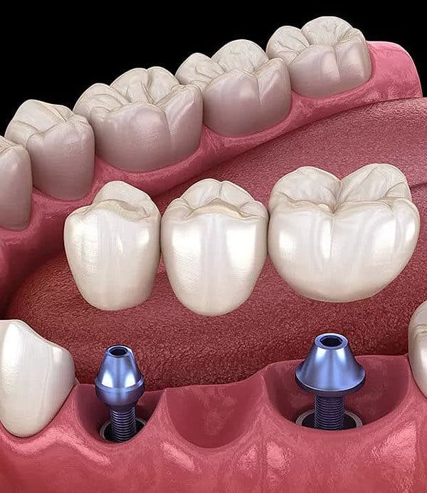 What-Are-Dental-Implants