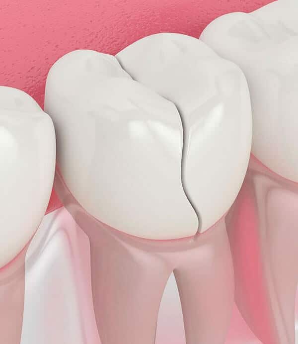 Why-Would-You-Need-A-Dental-Implant