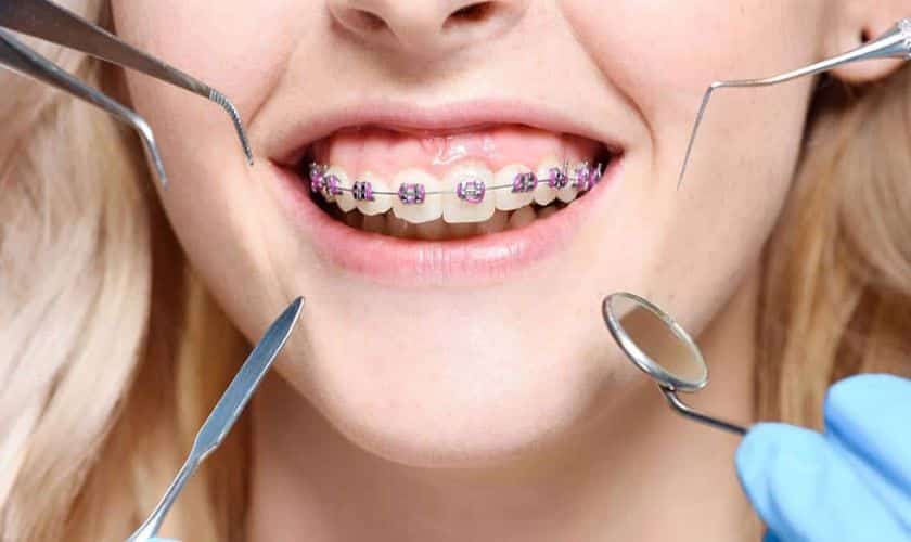 Straighten Your Smile with Orthodontics-improving your oral health