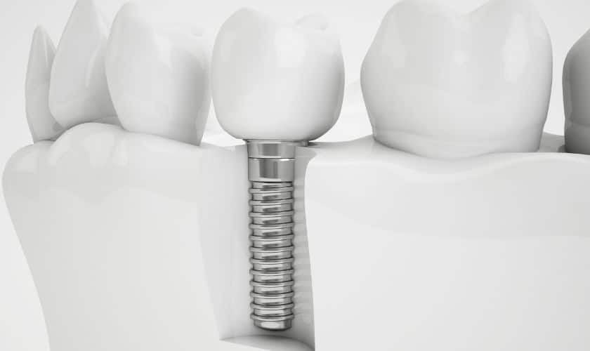 Effortless Dental Implants